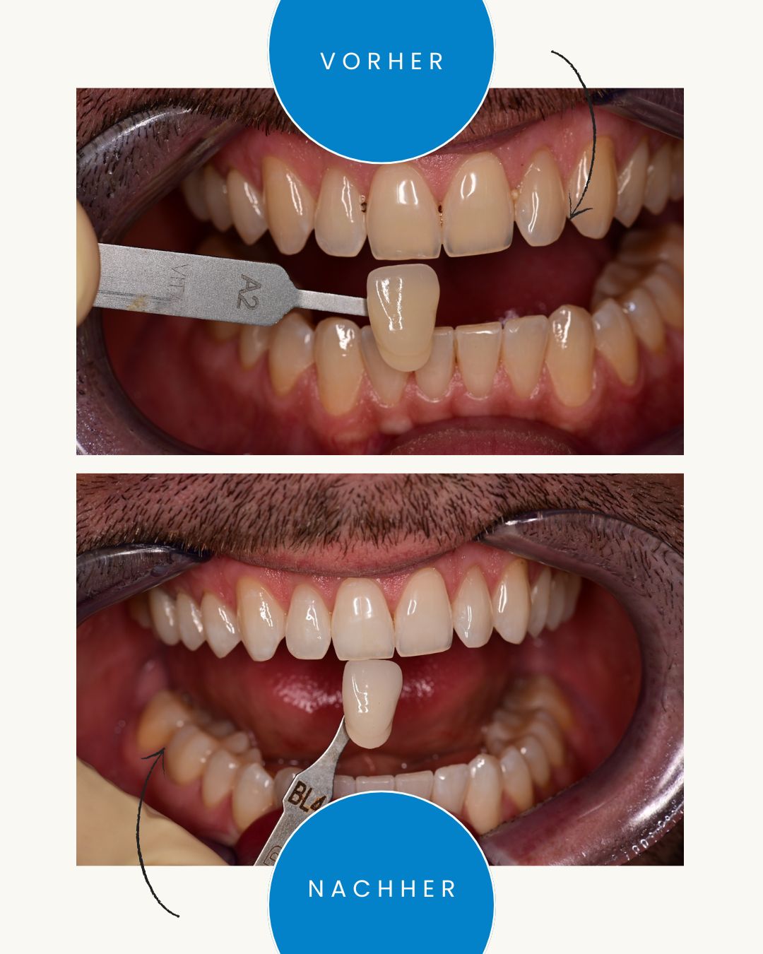 zahnaufhellung 2